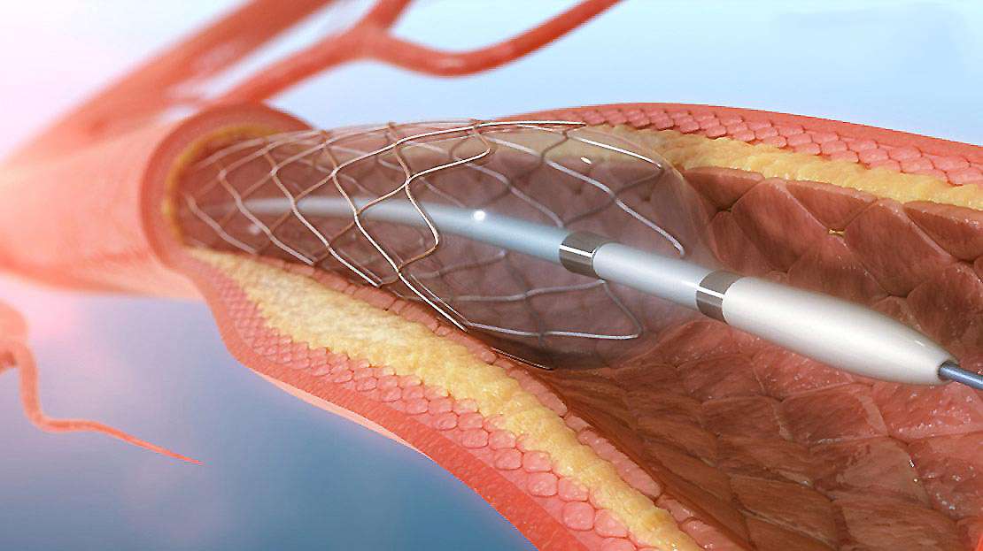 Damar Tıkanıklığı Tedavisi: Anjioplasti ve Stent Yerleştirme